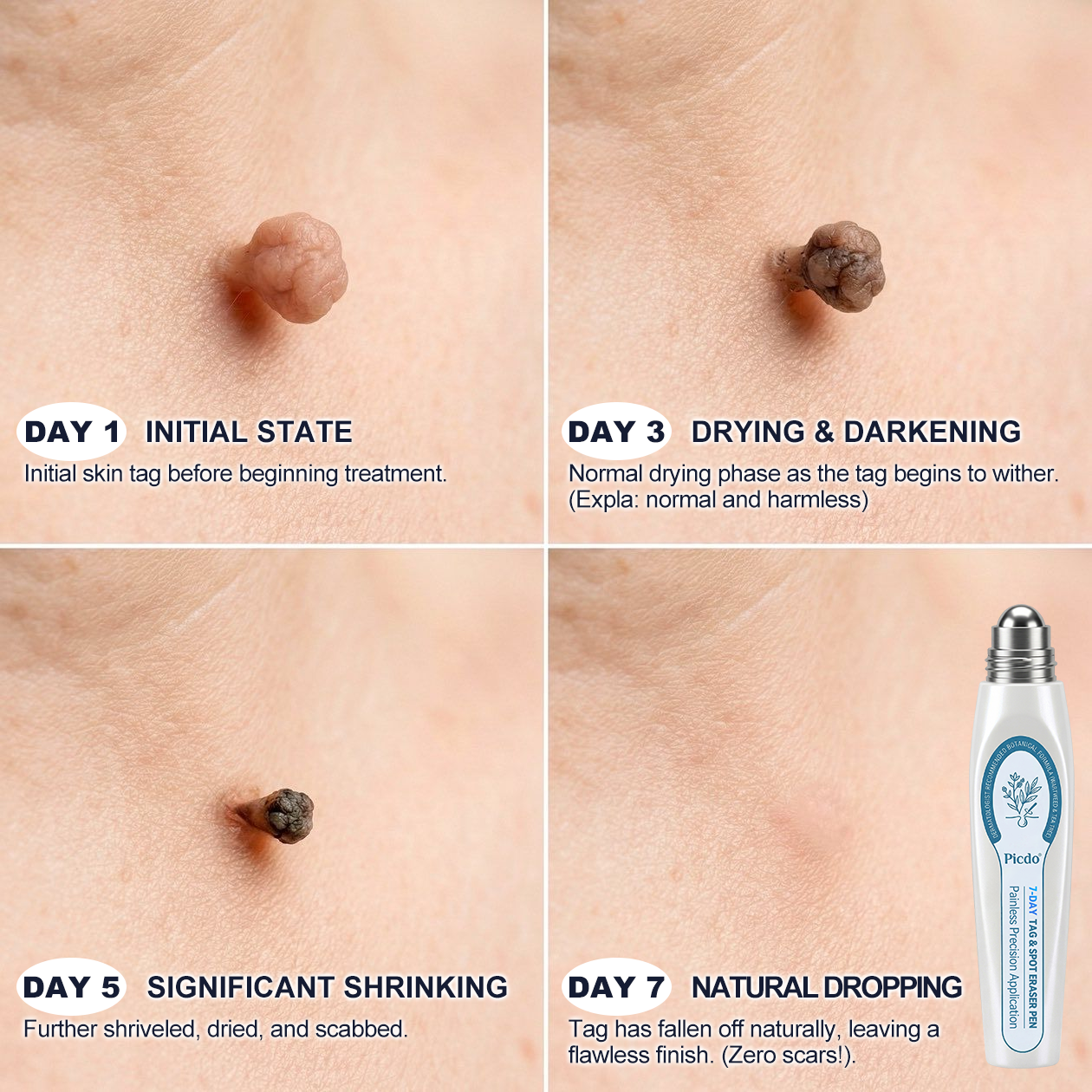 🎁🎁𝐏i𝐜𝐝o®7-𝐷𝑎𝑦 𝗧𝐚𝐠 & 𝗦𝗽𝐨𝐭 𝐄𝐫𝒂𝒔𝒆𝒓(Zero Pain, Zero 𝐒𝐜𝐚𝒓𝒔 Rollerball)