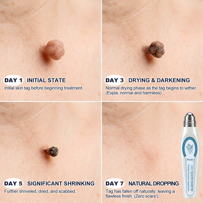 🎁🎁𝐏i𝐜𝐝o®7-𝐷𝑎𝑦 𝗧𝐚𝐠 & 𝗦𝗽𝐨𝐭 𝐄𝐫𝒂𝒔𝒆𝒓(Zero Pain, Zero 𝐒𝐜𝐚𝒓𝒔 Rollerball)